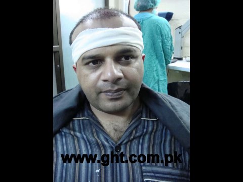 Best FUE Doctor in Pakistan | Cheap and Affordable FUE Hair Transplant in Islamabad | FUE Hair Transplant in Lahore