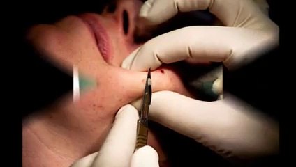 Mole Removal Procedure in His Office At the Center for Aesthetic Modernism