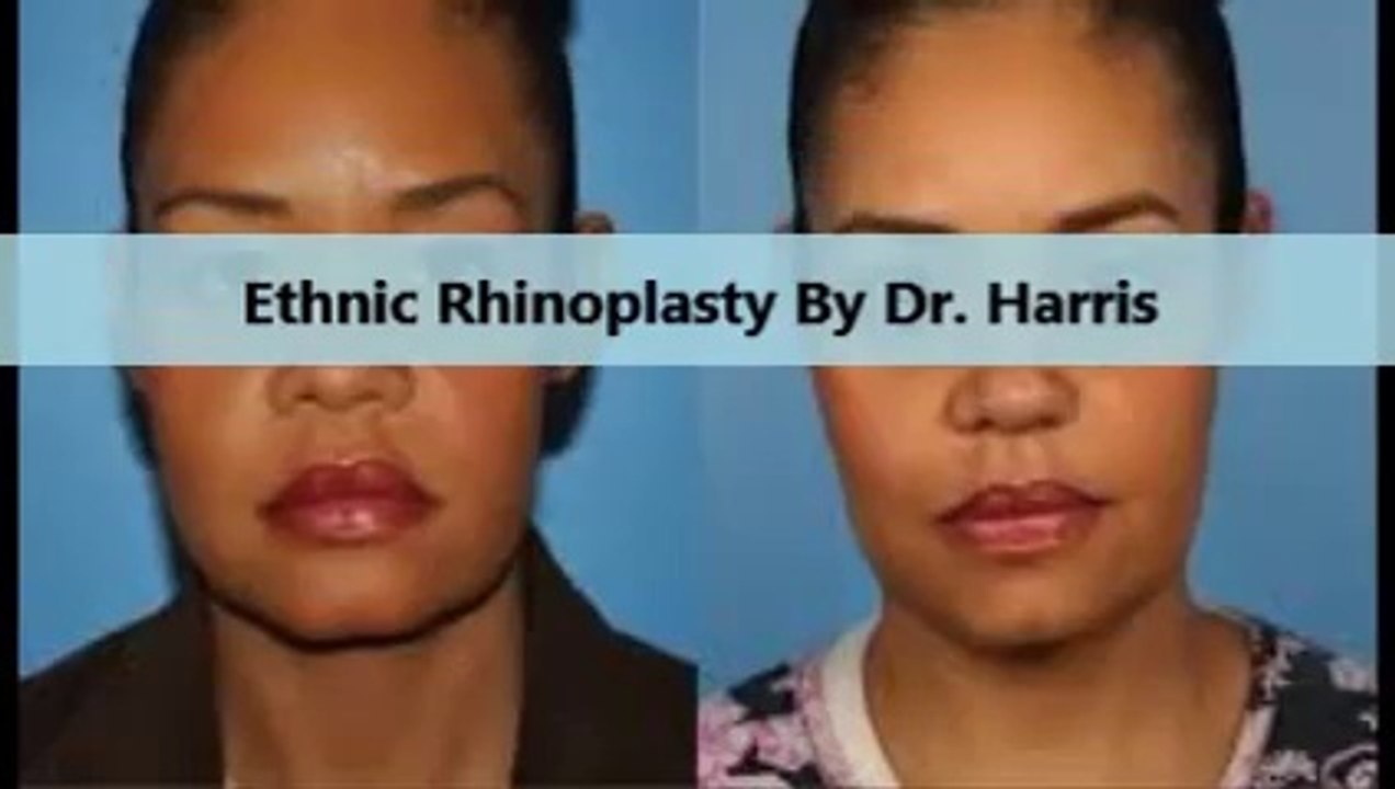 Center for Aesthetic Modernism : Rhinoplasty Plastic Surgery Operate By Dr. Harris