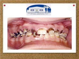 Root Canal Therapy What Is It and Why Do I Need It