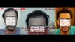 hairline design by FUE hair transplant in Pakistan, Laser Hair Transplant Pakistan