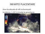 Lesioni ipoecogene della placenta