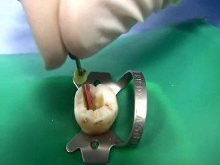 Travaux Pratiques pour étudiant en dentaire : l'obturation canalaire latéral à froid