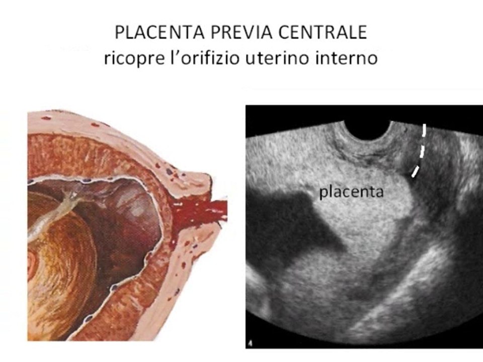 10 Placenta previa