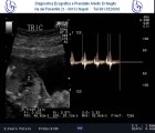Caso Clinico Arteria ombelicale singola 16 settimane