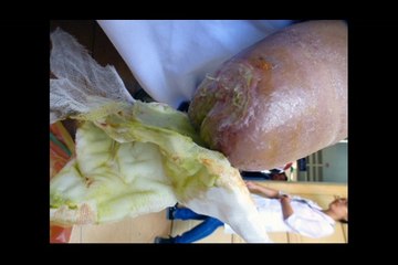 Mẹ khóc lặng nhìn con mỗi ngày rụng mất một phần cơ thể - Tấm lòng nhân ái - Báo Dân trí_3