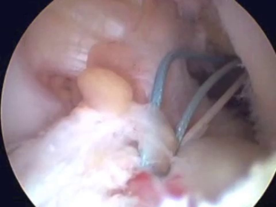 Chirurgie du ligament croisé antérieur - Ligamentoplastie - Technique DIDT