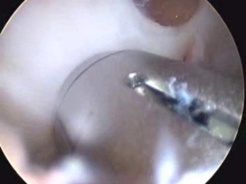 Chirurgie du genou - Arthrose du genou - Greffe de cartilage - Mozaicplasty