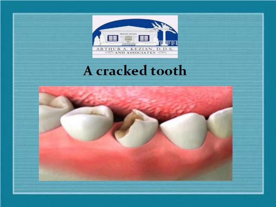 what is root canal treatment?