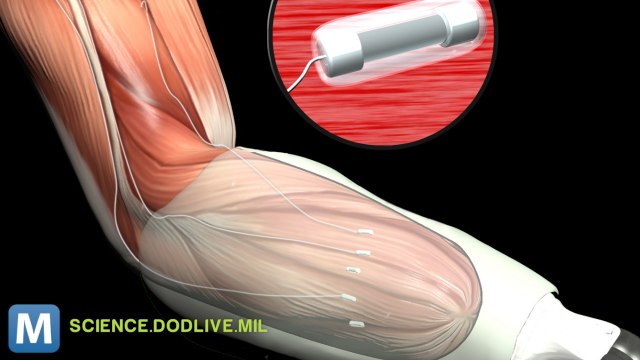 Rewiring Nerves for Mind-Controlled Prosthetics