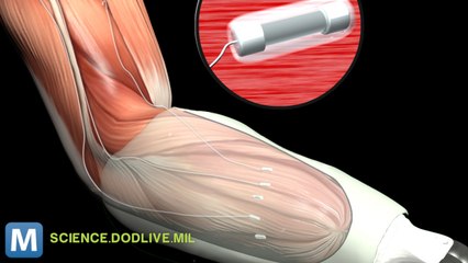 Rewiring Nerves for Mind-Controlled Prosthetics