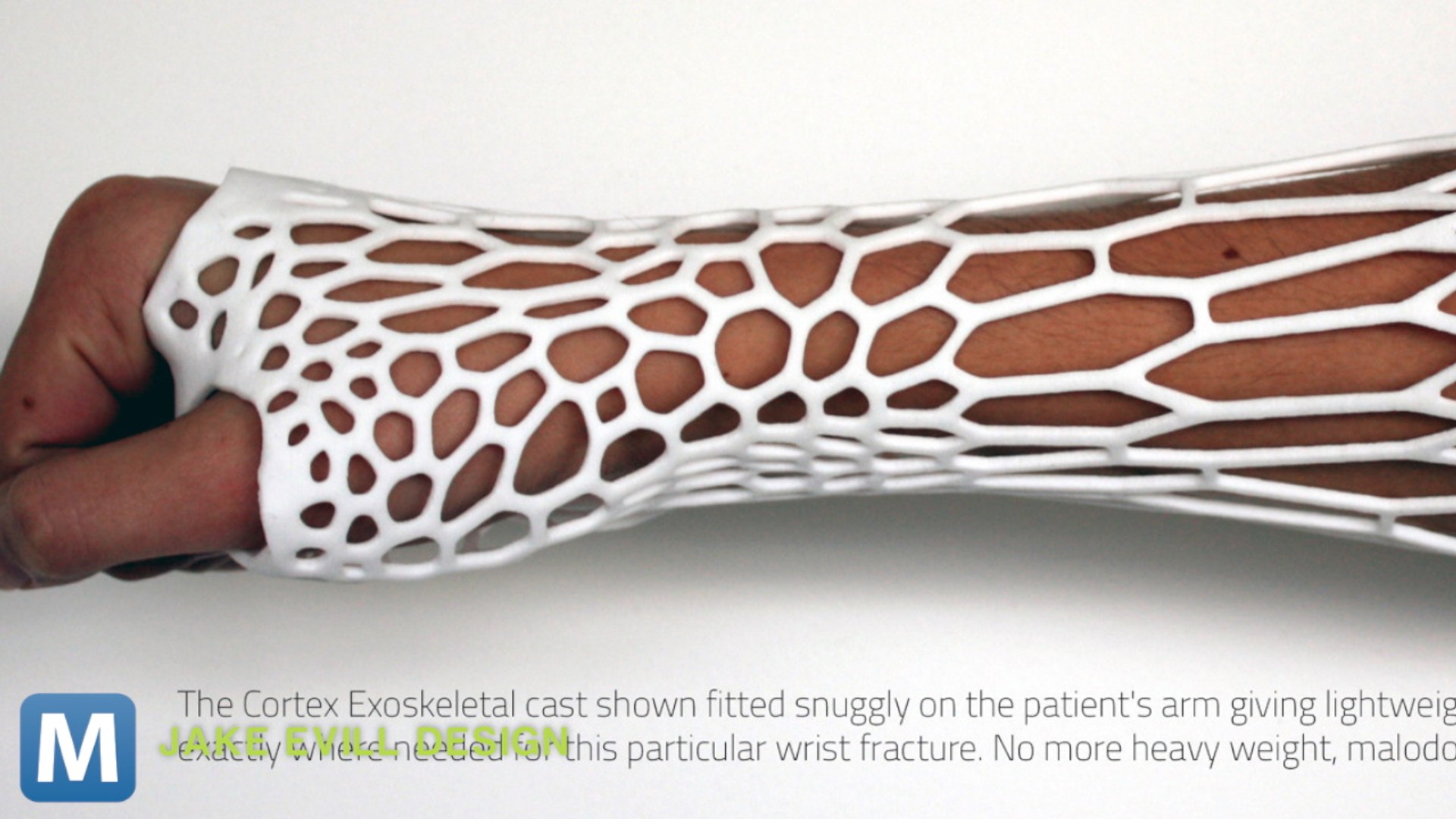 Modernizing the Plaster Cast with a 3D Printer - video Dailymotion