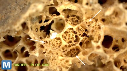 Earliest Example of Human with Cancer Found in 3,000-Year-Old Skeleton