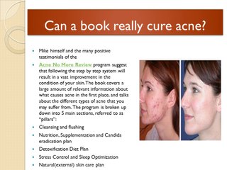 Acne No More Review - Is It Worth Your Time & Money?