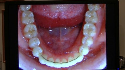 Invisalign - New York City Case Study