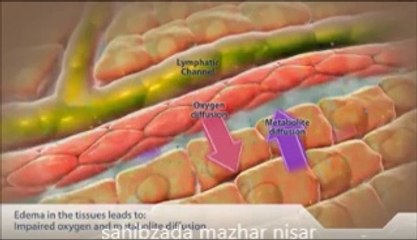 fluid overload on tissues