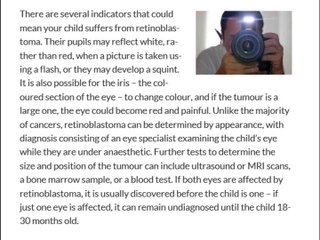 Brian Barso | Retinoblastoma – the children’s eye cancer