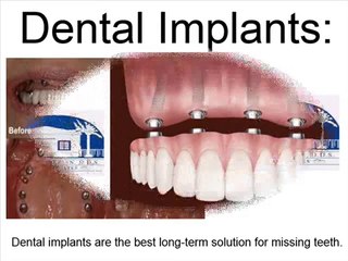 What are dental implants