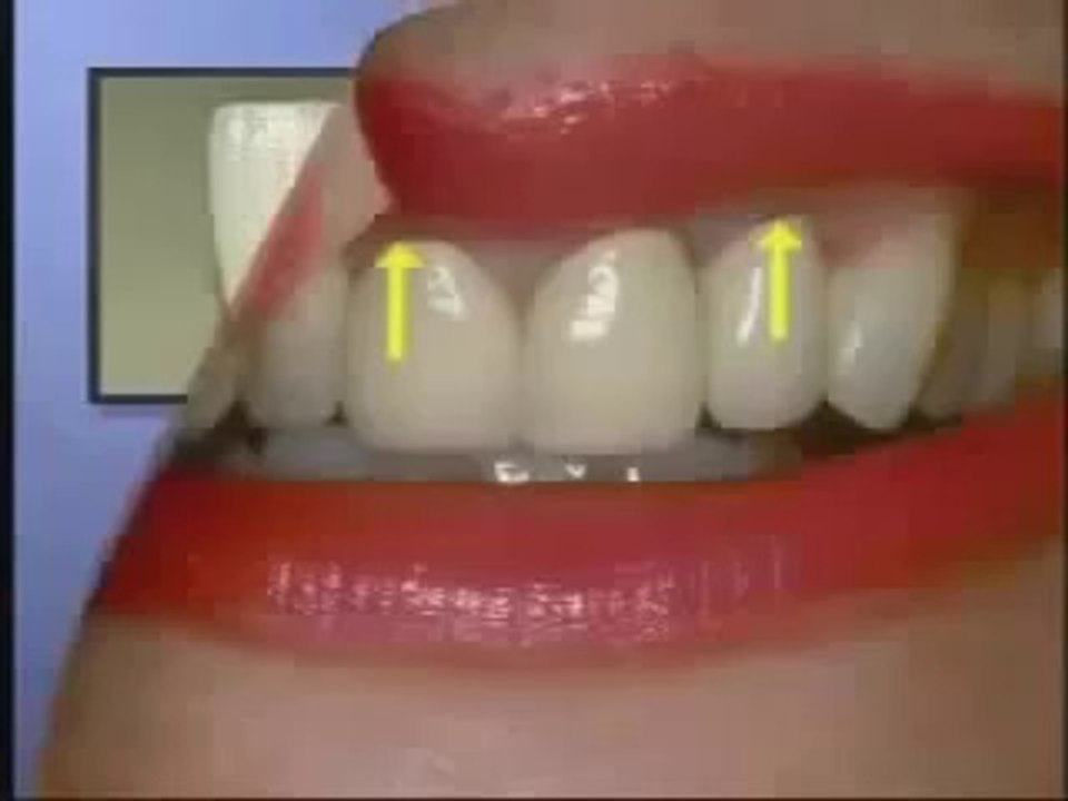 Sự khác nhau giữa răng sứ lõi kim loại và răng toàn sứ HÓT clip 2014.