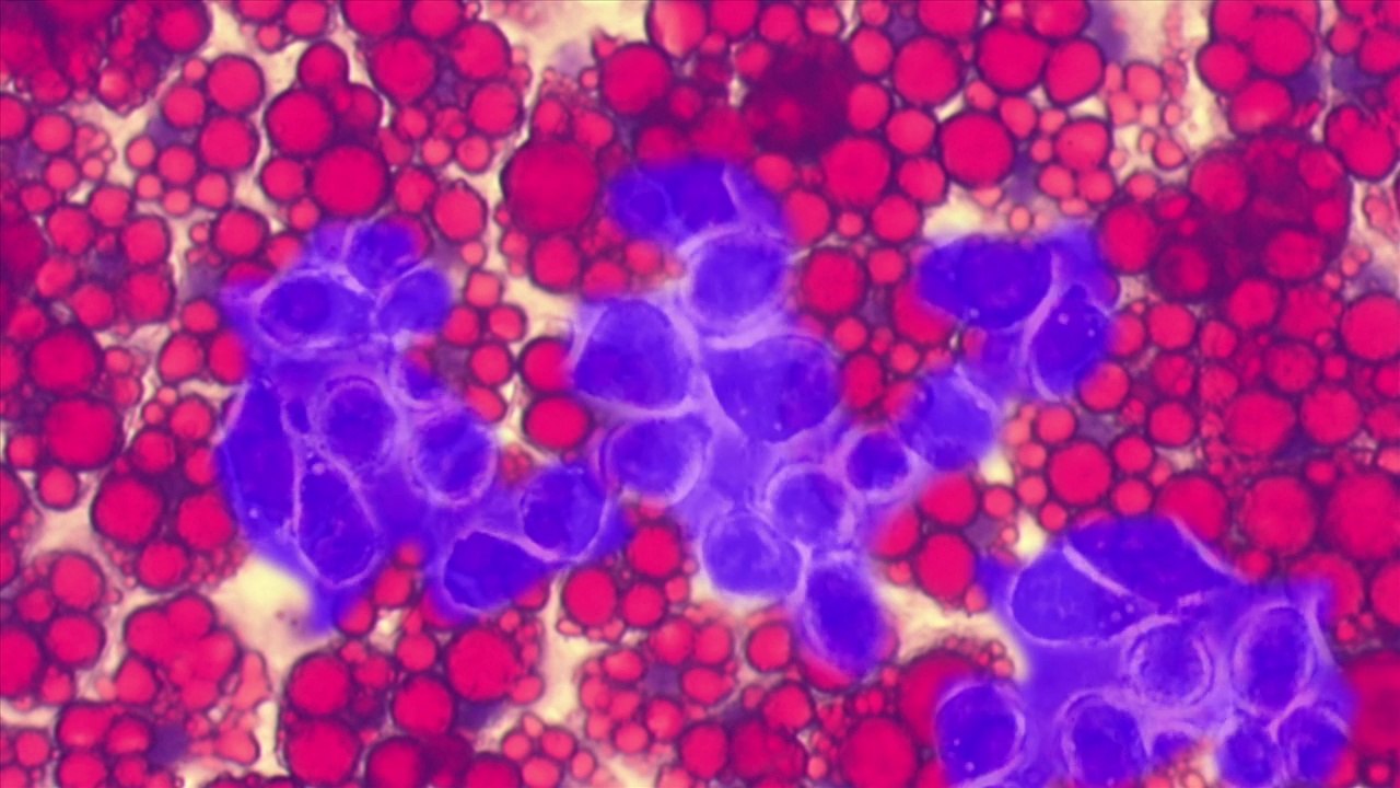 Obésité et complications