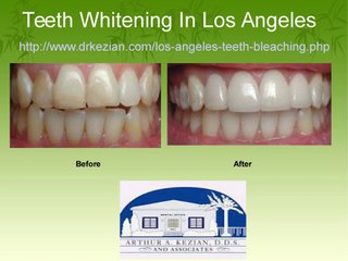 Best Home Remedies of Teeth Whitening