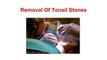 Tonsil Stones Prevention | Home Remedies & Treatment