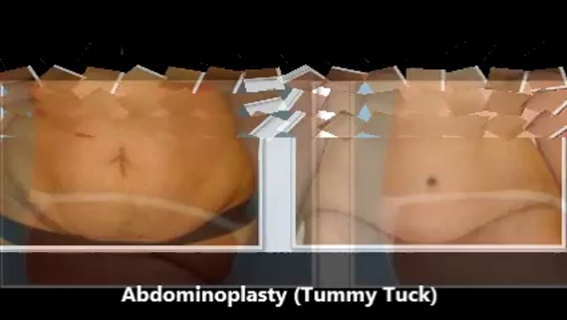 EBS Plastic Surgery : abdominoplasty procedure