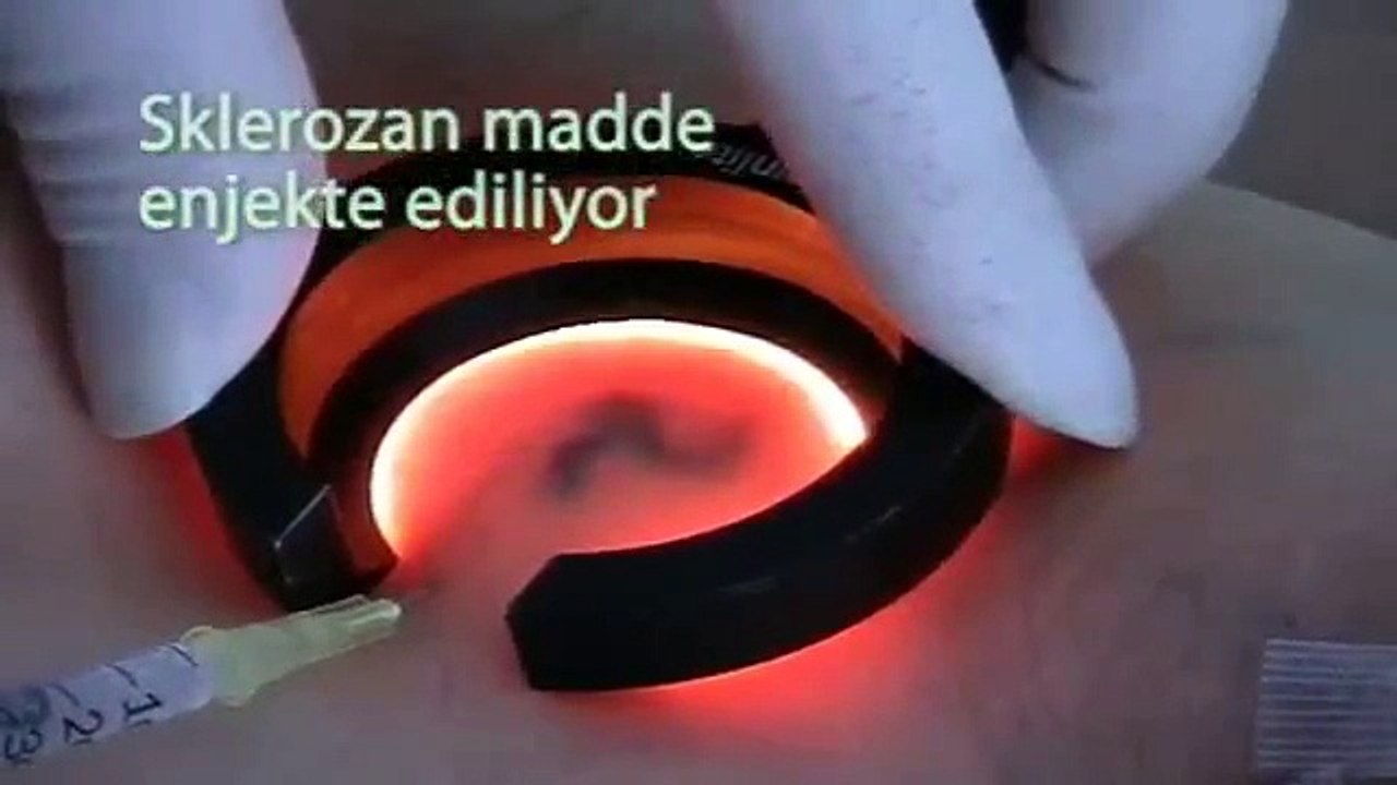 Kılcal Damar ve Varis Tedavileri - Fragman