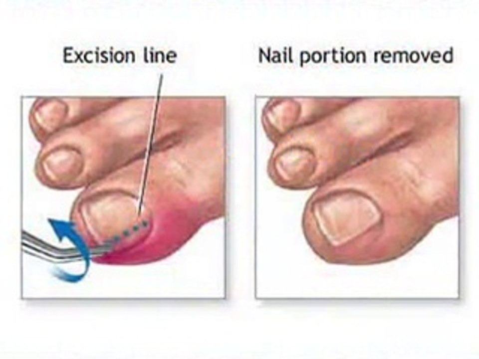 Fort Worth and Arlington, TX - Ingrown Toenail - Podiatrist Glen Beede, DPM