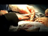 Stitching the abdominal incision after a Cesarean section delivery