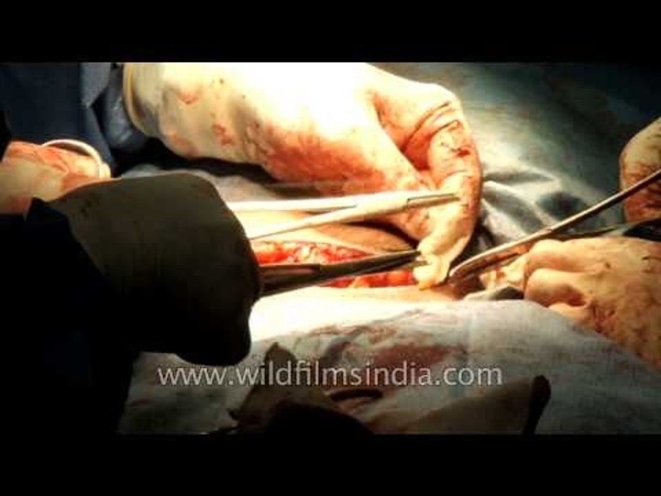 Stitching the abdominal incision after a Cesarean section delivery