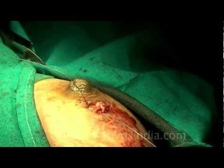 Stitching the incision to stop blood loss...