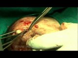 The fluid filled cyst inside the breast...