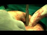 Breast cancer surgery at closer look...