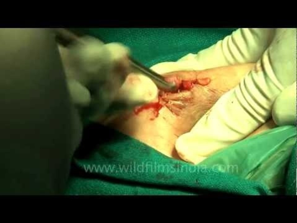 Cutting breast skin for removing cysts