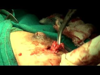 Digging in the breast incision to locate the cyst!