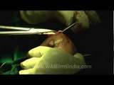 Surgery for fibroids in breast