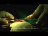 Breast cancer tumor removal through operation..