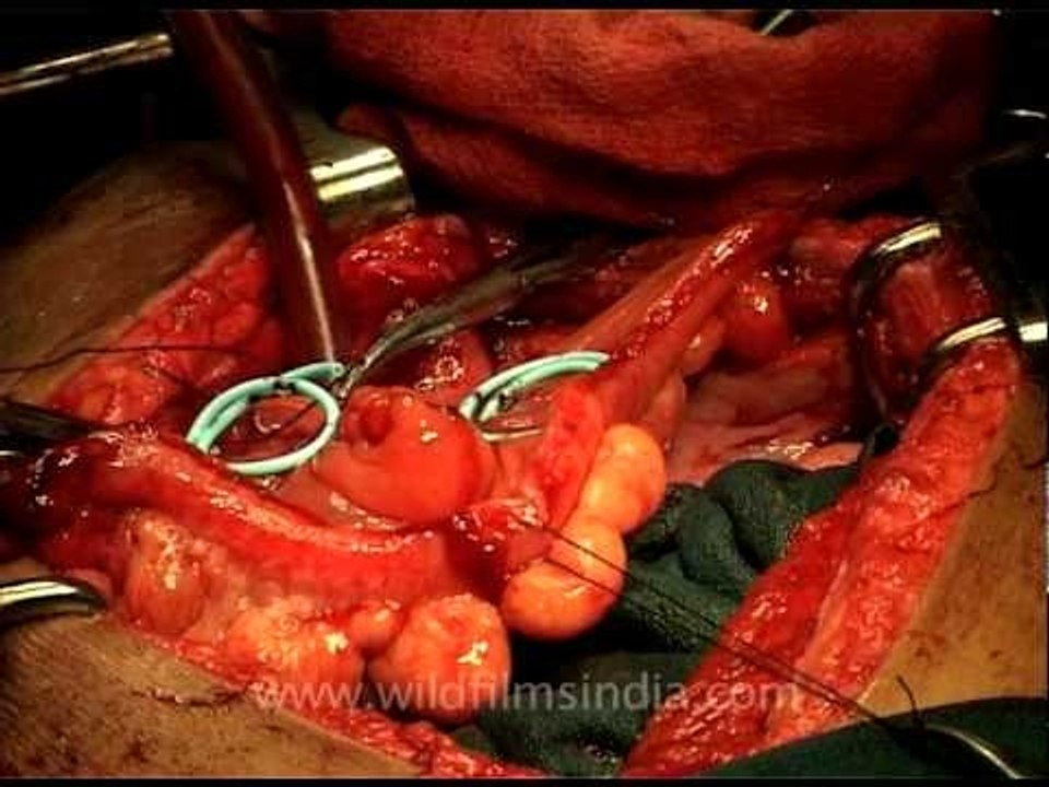 Internal stitching during Abdominal surgery!
