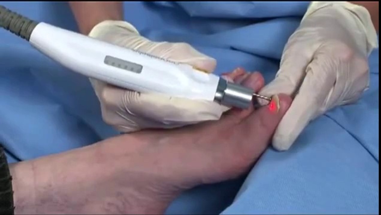 Laser Hair Removal Long Island County NY