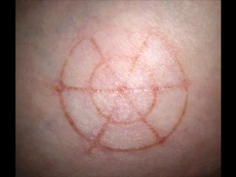 Étranges traces circulaires cutanées