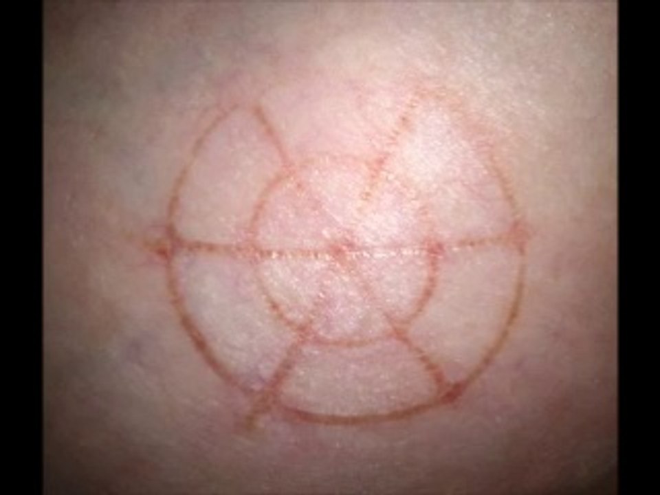 Étranges traces circulaires cutanées