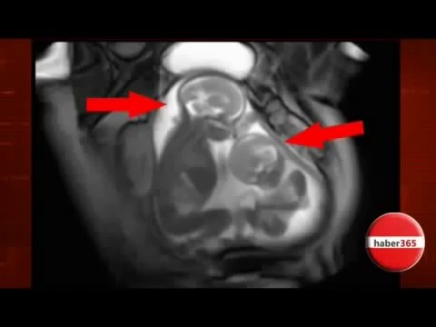 Anne karnında ikiz bebekler Kavgası -