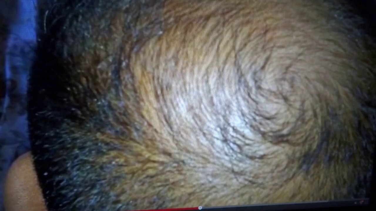 SEVERE BALDNESS  VS  ZX42