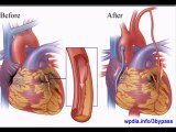 What is BYPASS SURGERY (open heart surgery)