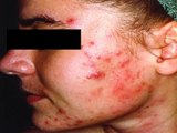 Acne No More Treatment - Acne No More Review