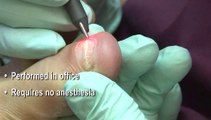 Podiatrist in Baltimore, Reisterstown and Owings Mills, MD - Laser Therapy Fungal Toenails