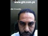 FUE Hair Transplant Pakistan - www.fuepakistan.com