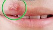 How To Cure Cold Sores On Lips Fast  Natural Treatment For Cold Sores (Fever Blisters)