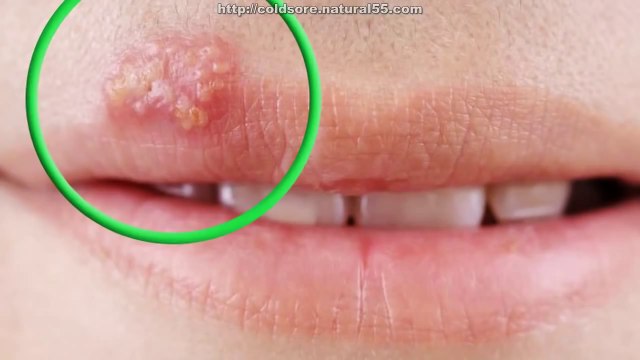 How To Cure Cold Sores On Lips Fast Natural Treatment For Cold Sores (Fever Blisters)
